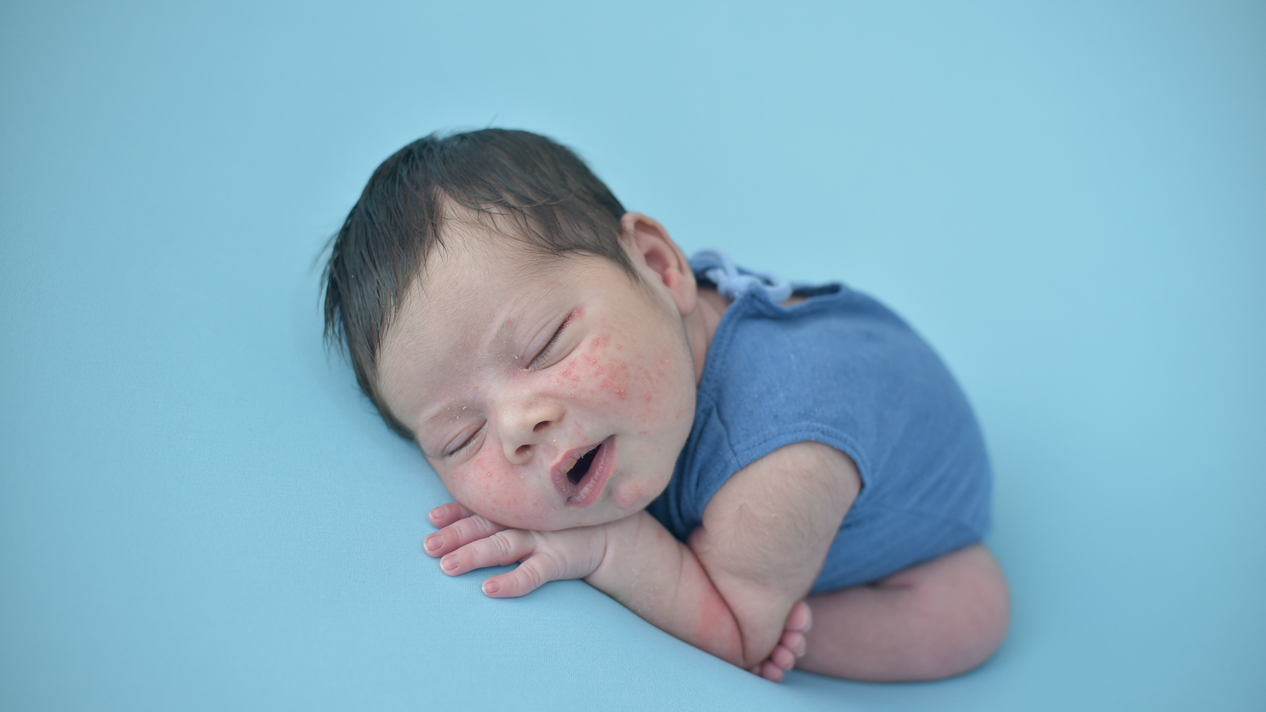 Bebê recém-nascido dormindo em fundo azul, com acne neonatal visível no rosto